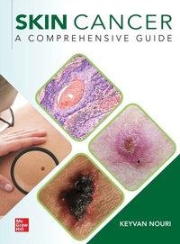 Abbildung von: Skin Cancer: A Comprehensive Guide - McGraw Hill LLC