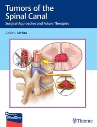 Abbildung von: Tumors of the Spinal Canal - Thieme Publishers