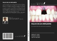 Abbildung von: FALLOS DE LOS IMPLANTES - Ediciones Nuestro Conocimiento