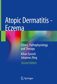 Abbildung von: Atopic Dermatitis - Eczema - Springer