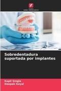Cover: Sobredentadura suportada por implantes - Edicoes Nosso Conhecimento