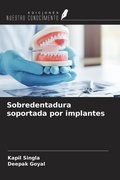 Cover: Sobredentadura soportada por implantes - Ediciones Nuestro Conocimiento