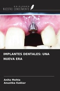 Cover: IMPLANTES DENTALES: UNA NUEVA ERA - Ediciones Nuestro Conocimiento