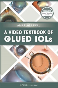 Abbildung von: Video Textbook of Glued IOLs - SLACK Incorporated