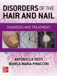 Abbildung von: Disorders of the Hair and Nail: Diagnosis and Treatment - McGraw Hill LLC