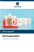 Cover: Periimplantitis - Verlag Unser Wissen