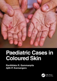 Abbildung von: Paediatric Cases in Coloured Skin - CRC Press