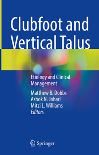 Abbildung von: Clubfoot and Vertical Talus - Springer