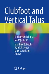 Abbildung von: Clubfoot and Vertical Talus - Springer