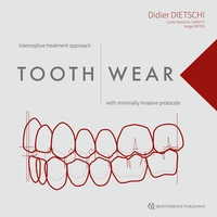 Abbildung von: Tooth Wear - Quintessenz Verlag