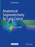 Bild: Anatomical Segmentectomy for Lung Cancer - Springer