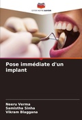 Cover: Pose immediate d'un implant - Editions Notre Savoir