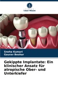 Cover: Gekippte Implantate - Verlag Unser Wissen