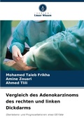 Cover: Vergleich des Adenokarzinoms des rechten und linken Dickdarms - Verlag Unser Wissen