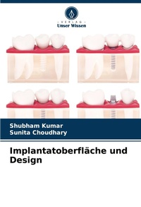 Enlarge image Cover: Implantatoberflaeche und Design - Verlag Unser Wissen