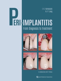 Abbildung von: Peri-Implantitis - Quintessence Publishing Co. Ltd.