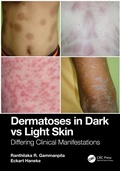 Cover: Dermatoses in Dark Vs Light Skin - CRC Press