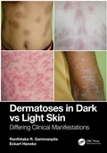 Cover: Dermatoses in Dark Vs Light Skin - CRC Press