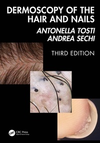 Abbildung von: Dermoscopy of the Hair and Nails 3e - CRC Press