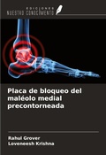 Cover: Placa de bloqueo del mal&eacute;olo medial precontorneada - Ediciones Nuestro Conocimiento