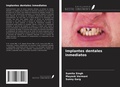 Cover: Implantes dentales inmediatos - Ediciones Nuestro Conocimiento