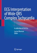 Bild: ECG Interpretation of Wide QRS Complex Tachycardia - Springer