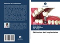 Cover: Okklusion bei Implantaten - Verlag Unser Wissen