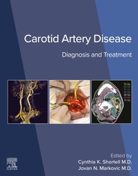 Abbildung von: Carotid Artery Disease - Elsevier