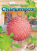 Cover: Chicken Pox - Bellwether Media by Flutterbee