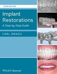 Abbildung von: Implant Restorations - Wiley