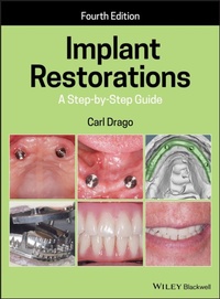 Abbildung von: Implant Restorations: A Step-By-Step Guide - Wiley-Blackwell